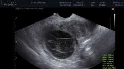 Corpus luteum on ultrasound - what does it mean?