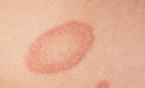 Ringworm in pregnant women: is it dangerous and how to treat it?