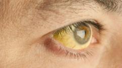 The sclera of the eye - what is it, what functions does it perform and what pathologies can the human eye have?