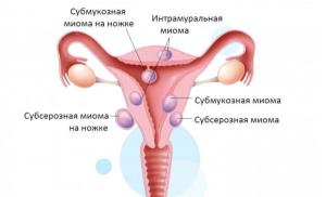 Is it possible to get pregnant with uterine fibroids and how will the pregnancy proceed?