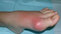 The first signs of gout and treatment regimen at home