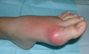 The first signs of gout and the treatment regimen at home