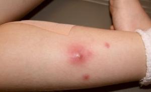 Methods for getting rid of bumps after injections: what to do to resolve