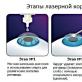 Laser vision correction using the PRK method: reviews, description, essence of the method