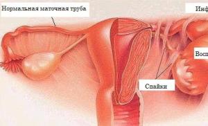 Hydrosalpinx: should the fallopian tube be removed?
