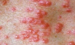 Causes of allergy rashes